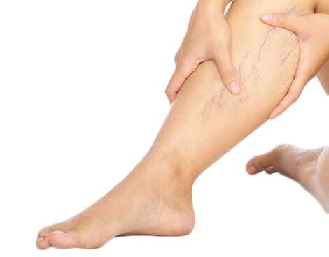 How to treat varicose veins with Neoveris