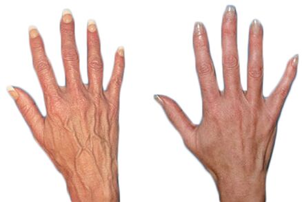 The effect of Neoveris in treating varicose veins on hands