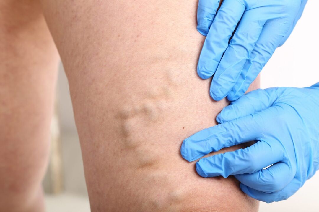 Symptoms of varicose veins