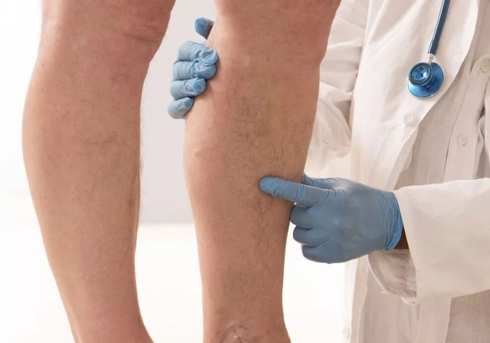 Treatment of varicose veins